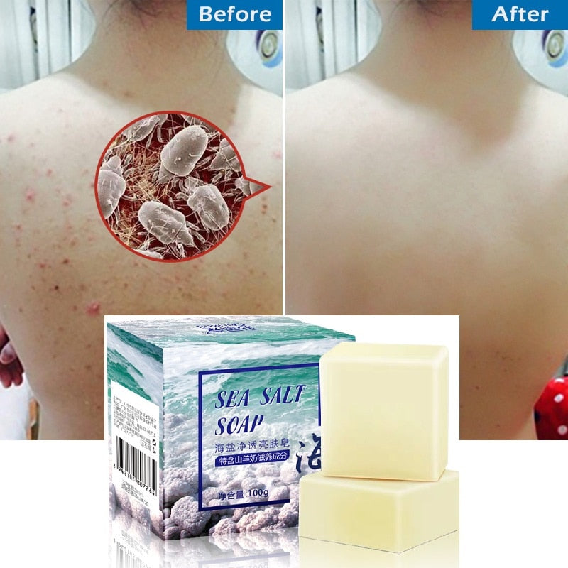 100g Removal Pimple Pores Acne Treatment Sea Salt Soap