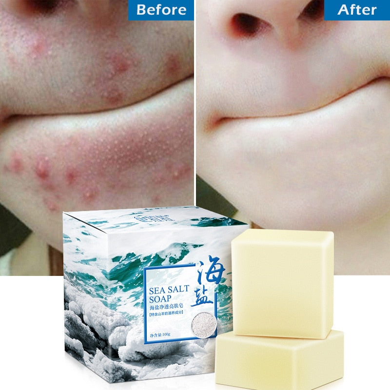 100g Sea Salt Soap Removal Pimple Pores Acne Treatment Cleaner